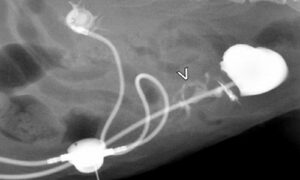 X-ray of extra-anatomic ureteric bypass device